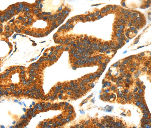 Immunohistochemistry of paraffin-embedded Human thyroid cancer tissue using SMYD4 Polyclonal Antibody at dilution 1:40