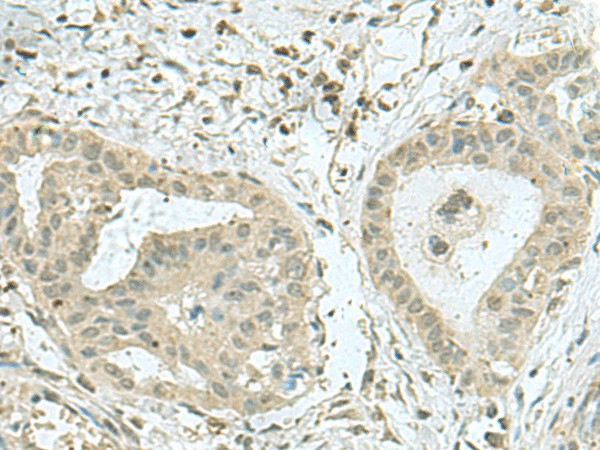 Immunohistochemistry of paraffin-embedded Human thyroid cancer tissue  using THTPA Polyclonal Antibody at dilution of 1:70(?200)