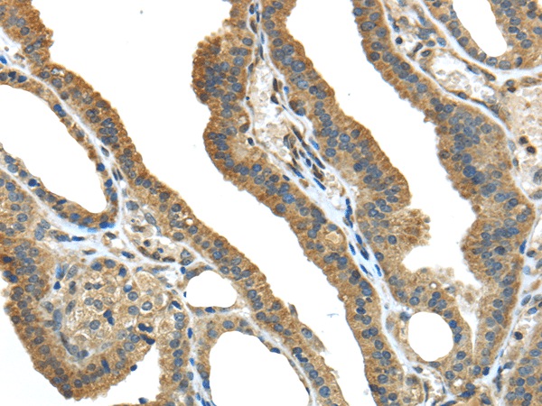 Immunohistochemistry of paraffin-embedded Human thyroid cancer tissue using TMPRSS13 Polyclonal Antibody at dilution 1:40