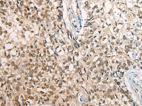 Immunohistochemistry of paraffin-embedded Human lung cancer tissue  using CDT1 Polyclonal Antibody at dilution of 1:45(?200)