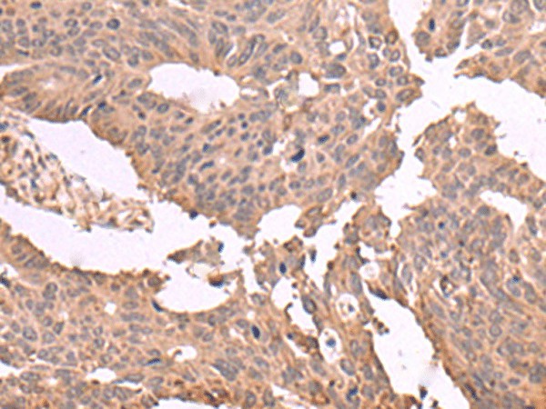 Immunohistochemistry of paraffin-embedded Human colorectal cancer tissue  using MAGEC2 Polyclonal Antibody at dilution of 1:60(?200)