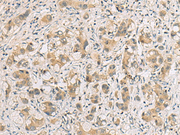 Immunohistochemistry of paraffin-embedded Human liver cancer tissue  using RTP4 Polyclonal Antibody at dilution of 1:80(?200)