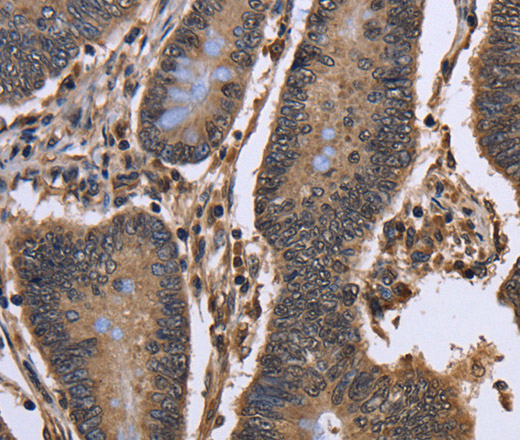 Immunohistochemistry of paraffin-embedded Human colon cancer using DCP1A Polyclonal Antibody at dilution of 1:50