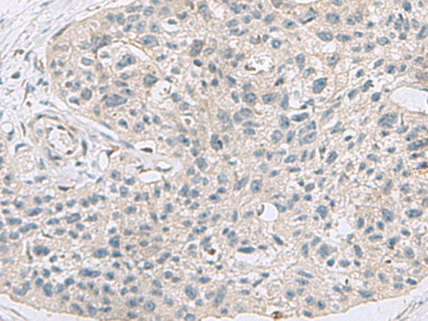 Immunohistochemistry of paraffin-embedded Human esophagus cancer tissue  using ABCA10 Polyclonal Antibody at dilution of 1:50(?200)