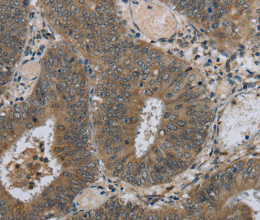 Immunohistochemistry of paraffin-embedded Human colon cancer tissue using HSD3B1 Polyclonal Antibody at dilution 1:40