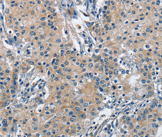 Immunohistochemistry of paraffin-embedded Human gastric cancer using TRIP4 Polyclonal Antibody at dilution of 1:50