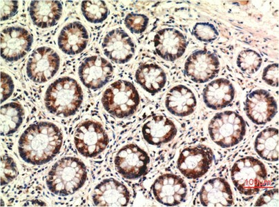 Immunohistochemistry of paraffin-embedded Human colon carcinoma tissue using PTEN Monoclonal Antibody at dilution of 1:200.