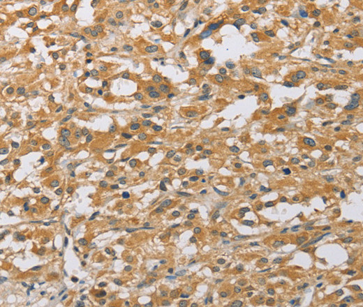 Immunohistochemistry of paraffin-embedded Human thyroid cancer tissue using ARHGEF1 Polyclonal Antibody at dilution 1:50