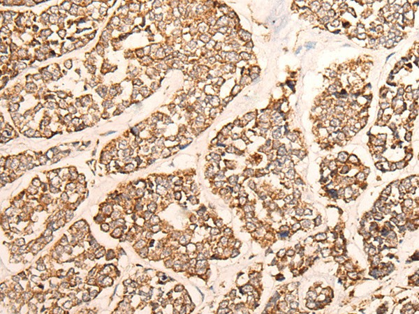 Immunohistochemistry of paraffin-embedded Human esophagus cancer tissue  using GRIA4 Polyclonal Antibody at dilution of 1:40(?200)