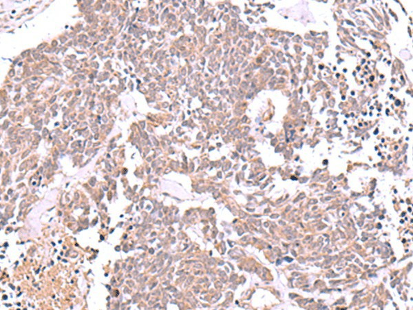 Immunohistochemistry of paraffin-embedded Human lung cancer tissue  using JDP2 Polyclonal Antibody at dilution of 1:40(?200)