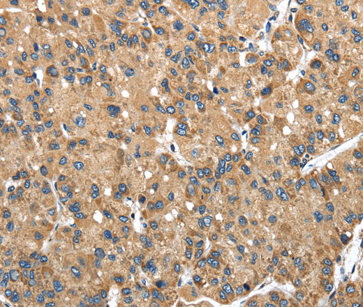 Immunohistochemistry of paraffin-embedded Human liver cancer using NDUFA5 Polyclonal Antibody at dilution of 1:40