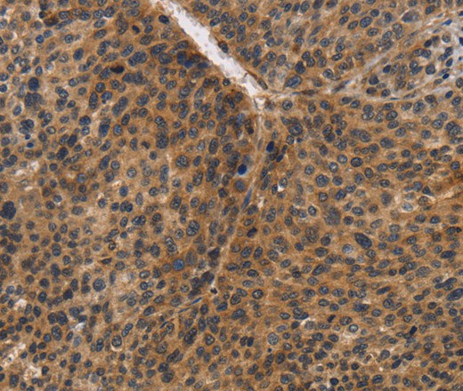 Immunohistochemistry of paraffin-embedded Human liver cancer using CDC34 Polyclonal Antibody at dilution of 1:50