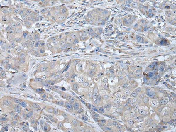 Immunohistochemistry of paraffin-embedded Human breast cancer tissue  using RASA1 Polyclonal Antibody at dilution of 1:40(?200)