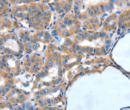 Immunohistochemistry of paraffin-embedded Human thyroid cancer tissue using XBP1 Polyclonal Antibody at dilution 1:60