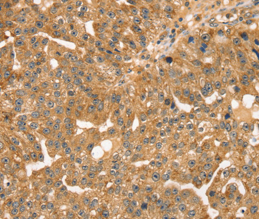 Immunohistochemistry of paraffin-embedded Human breast cancer using STX10 Polyclonal Antibody at dilution of 1:35