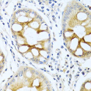 Immunohistochemistry of paraffin-embedded human colon using PKC alpha Polyclonal antibody at dilution of 1:100 (40x lens).Perform microwave antigen retrieval with 10 mM PBS buffer pH 7.2 before commencing with IHC staining protocol.