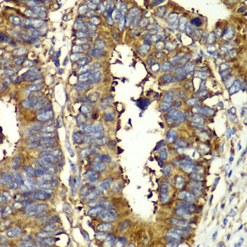 Immunohistochemistry of paraffin-embedded Human colon carcinoma using QARS Polyclonal Antibody at dilution of  1:100 (40x lens).