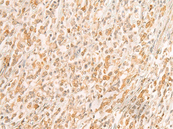 Immunohistochemistry of paraffin-embedded Human gastric cancer tissue  using SREBF2 Polyclonal Antibody at dilution of 1:50(?200)