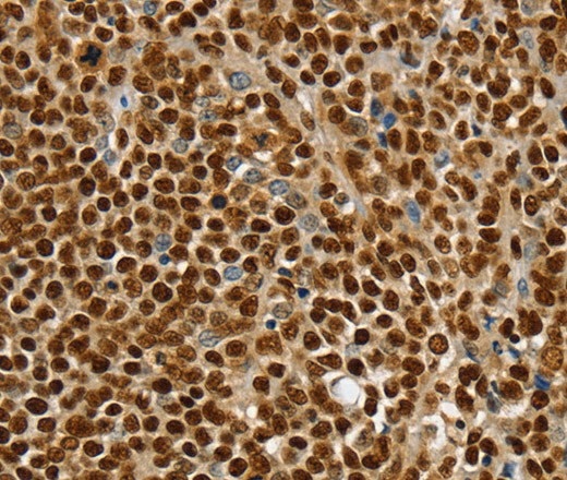 Immunohistochemistry of paraffin-embedded Human ovarian cancer using SSB Polyclonal Antibody at dilution of 1:30