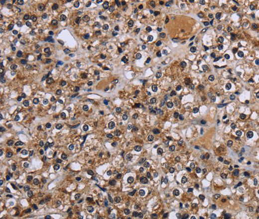 Immunohistochemistry of paraffin-embedded Human prostate cancer using c-Rel Polyclonal Antibody at dilution of 1:30