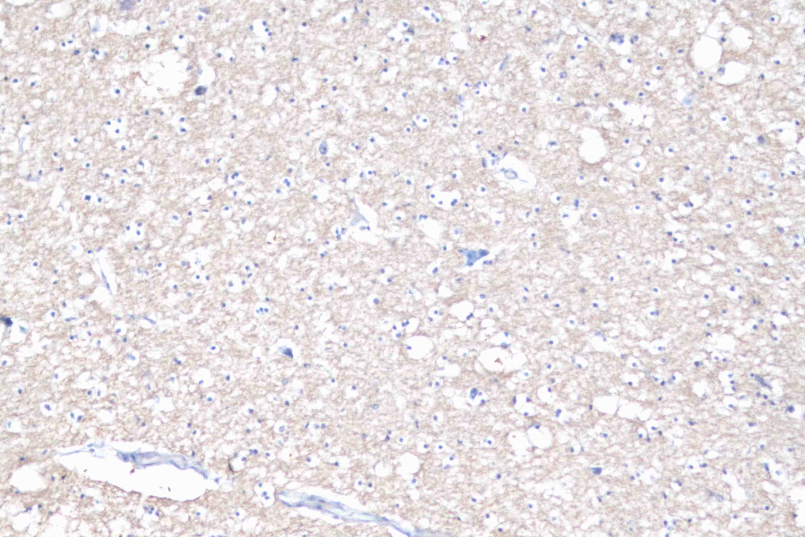 Immunohistochemistry of paraffin-embedded Human breast cancer tissue  using MOG Polyclonal Antibody at dilution of 1:25(?200)