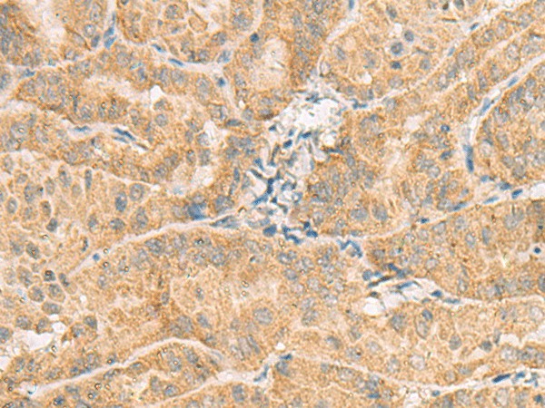 Immunohistochemistry of paraffin-embedded Human thyroid cancer tissue  using NCOA4 Polyclonal Antibody at dilution of 1:130(?200)