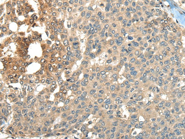 Immunohistochemistry of paraffin-embedded Human liver cancer tissue  using MAPK4 Polyclonal Antibody at dilution of 1:35(?200)