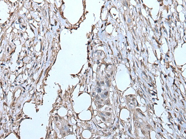 Immunohistochemistry of paraffin-embedded Human colorectal cancer tissue  using TPT1 Polyclonal Antibody at dilution of 1:85(?200)