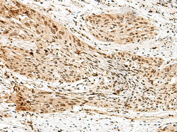 Immunohistochemistry of paraffin-embedded Human esophagus cancer tissue  using RBM15 Polyclonal Antibody at dilution of 1:70(?200)