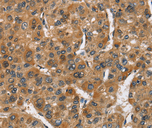 Immunohistochemistry of paraffin-embedded Human liver cancer tissue using CREB2 Polyclonal Antibody at dilution 1:50