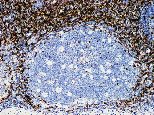 Immunohistochemistry of paraffinembedded Human tonsil tissue with CD5 Monoclonal Antibody(Antigen repaired by EDTA).