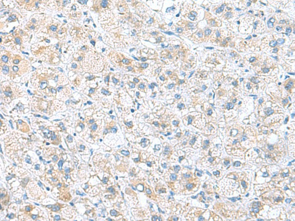 Immunohistochemistry of paraffin-embedded Human liver cancer tissue  using DNAL1 Polyclonal Antibody at dilution of 1:50(?200)