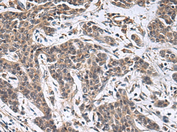 Immunohistochemistry of paraffin-embedded Human colorectal cancer tissue  using MBL2 Polyclonal Antibody at dilution of 1:25(?200)