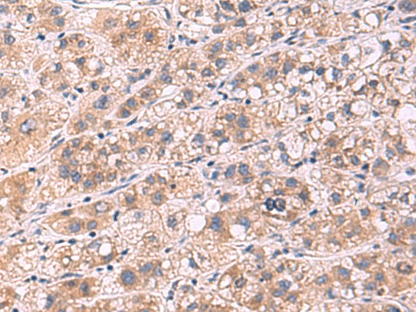 Immunohistochemistry of paraffin-embedded Human liver cancer tissue  using PPEF1 Polyclonal Antibody at dilution of 1:90(?200)