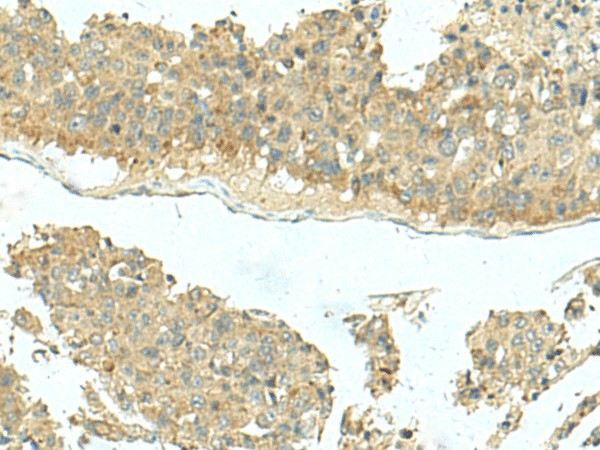 Immunohistochemistry of paraffin-embedded Human liver cancer tissue  using KIR2DL5A Polyclonal Antibody at dilution of 1:40(?200)