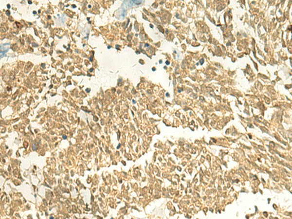 Immunohistochemistry of paraffin-embedded Human lung cancer tissue  using EEF1AKMT2 Polyclonal Antibody at dilution of 1:50(?200)