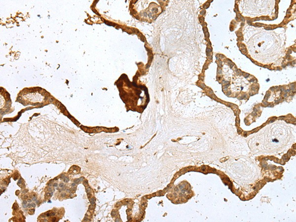 Immunohistochemistry of paraffin-embedded Human thyroid cancer tissue  using UBE2Z Polyclonal Antibody at dilution of 1:35(?200)