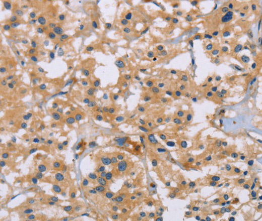 Immunohistochemistry of paraffin-embedded Human thyroid cancer using ACTN4 Polyclonal Antibody at dilution of 1:60