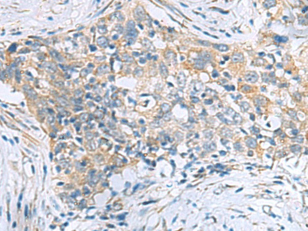 Immunohistochemistry of paraffin-embedded Human esophagus cancer tissue  using PPIC Polyclonal Antibody at dilution of 1:50(?200)