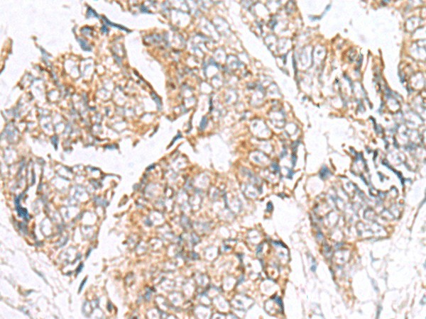 Immunohistochemistry of paraffin-embedded Human colorectal cancer tissue  using GPC2 Polyclonal Antibody at dilution of 1:40(?200)