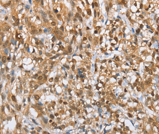 Immunohistochemistry of paraffin-embedded Human esophagus cancer tissue using MMP12 Polyclonal Antibody at dilution of 1:60