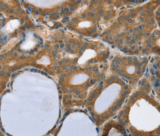 Immunohistochemistry of paraffin-embedded Human thyroid cancer using TRIM3 Polyclonal Antibody at dilution of 1:45