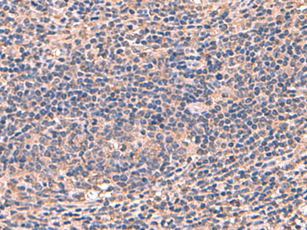 Immunohistochemistry of paraffin-embedded Human cervical cancer tissue  using AHCYL1 Polyclonal Antibody at dilution of 1:70(?200)