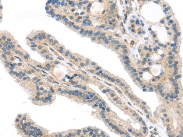 Immunohistochemistry of paraffin-embedded Human thyroid cancer using VPS26A Polyclonal Antibody at dilution of 1/40