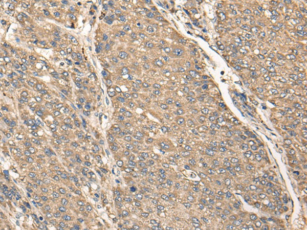 Immunohistochemistry of paraffin-embedded Human liver cancer tissue  using C17orf67 Polyclonal Antibody at dilution of 1:50(?200)