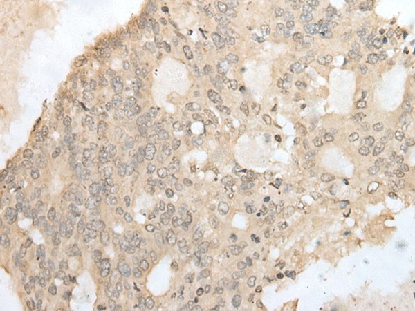 Immunohistochemistry of paraffin-embedded Human colorectal cancer tissue  using ZZZ3 Polyclonal Antibody at dilution of 1:50(?200)