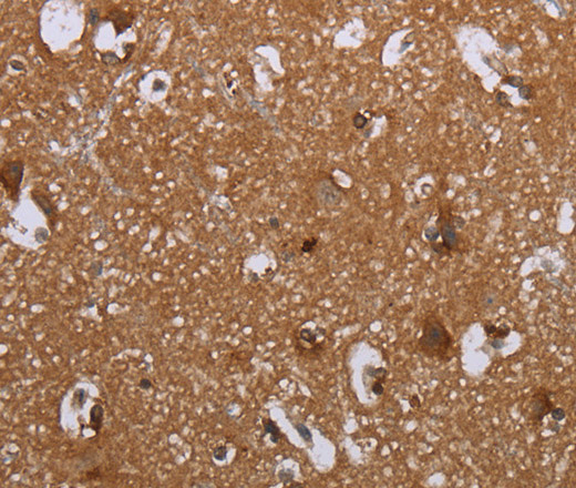 Immunohistochemistry of paraffin-embedded Human brain tissue using LIMK1 Polyclonal Antibody at dilution 1:40