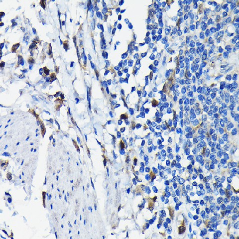 Immunohistochemistry of paraffin-embedded human colon carcinoma using STK19 Polyclonal Antibody at dilution of 1:100 (40x lens).Perform high pressure antigen retrieval with 10 mM citrate buffer pH 6.0 before commencing with IHC staining protocol.