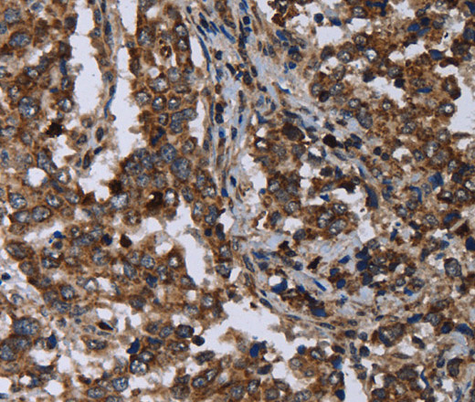 Immunohistochemistry of paraffin-embedded Human liver cancer tissue using DNAJC15 Polyclonal Antibody at dilution 1:40