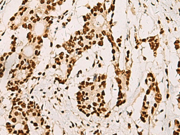 Immunohistochemistry of paraffin-embedded Human colorectal cancer tissue  using ELF5 Polyclonal Antibody at dilution of 1:70(?200)